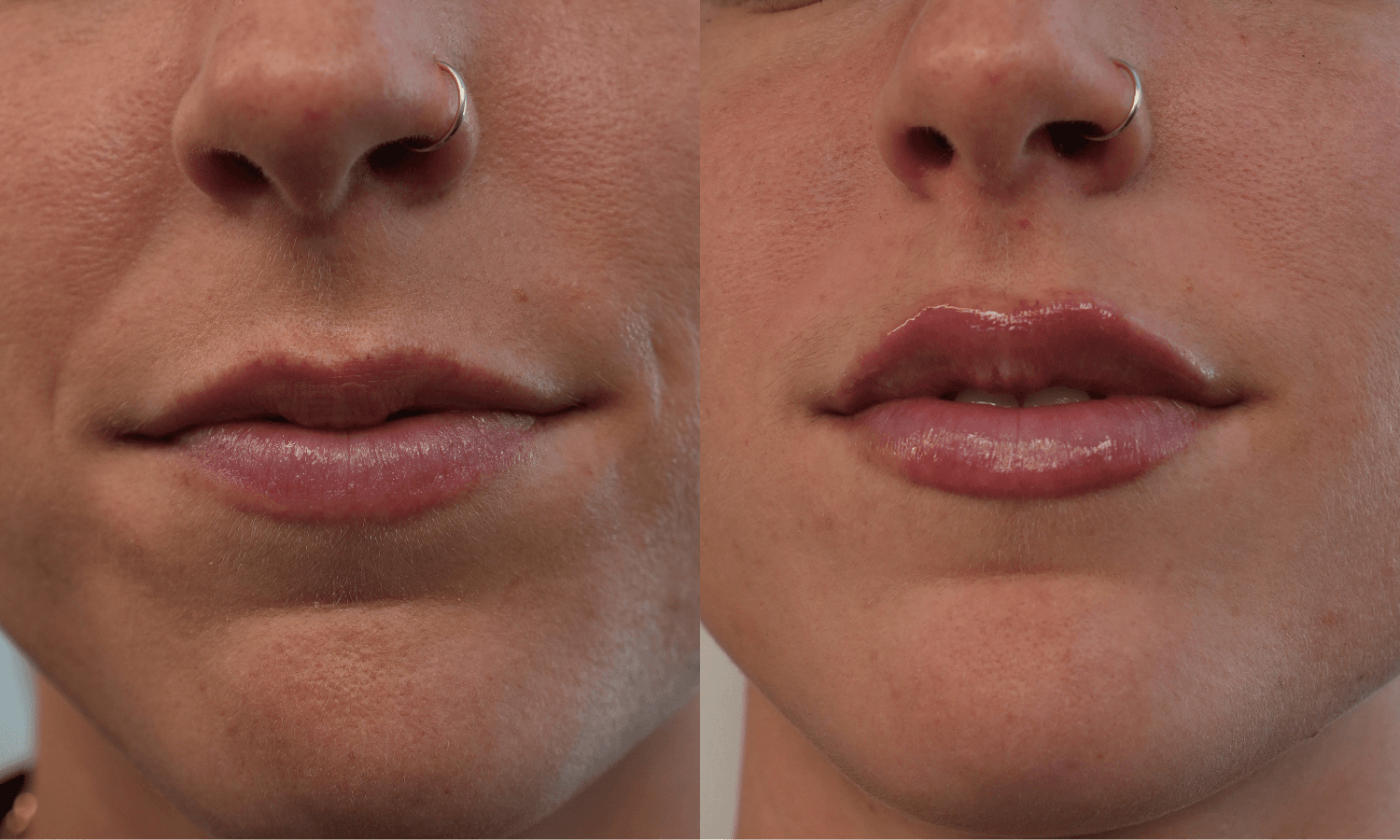 Aesthetics Ad - $100 Off FIller 4 Untitled design 2