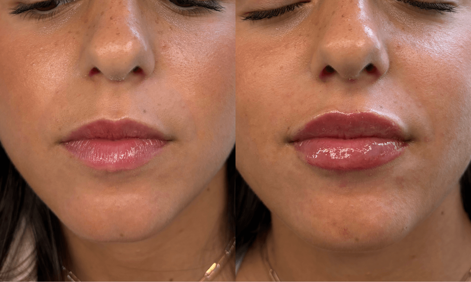 Aesthetics Ad - $100 Off FIller 3 Untitled design