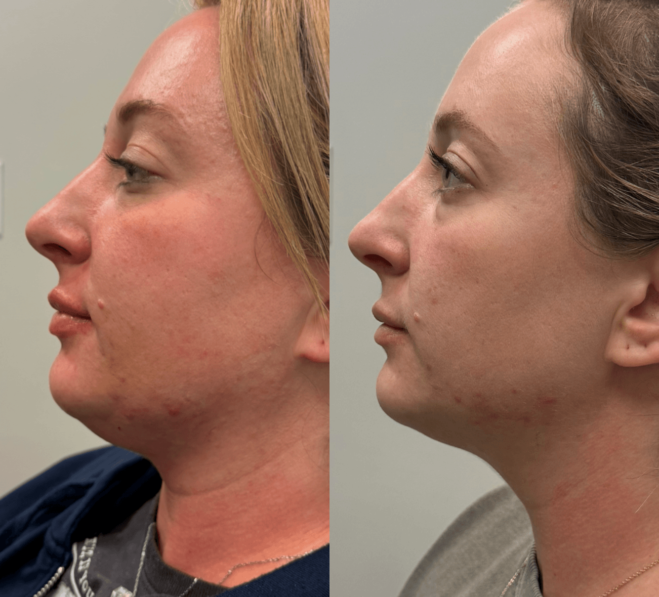 Injectables 3 Services Images 3